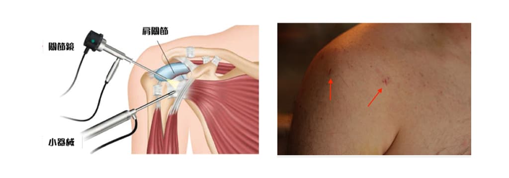 adhesive-capsulitis-frozen-shoulder-info-3