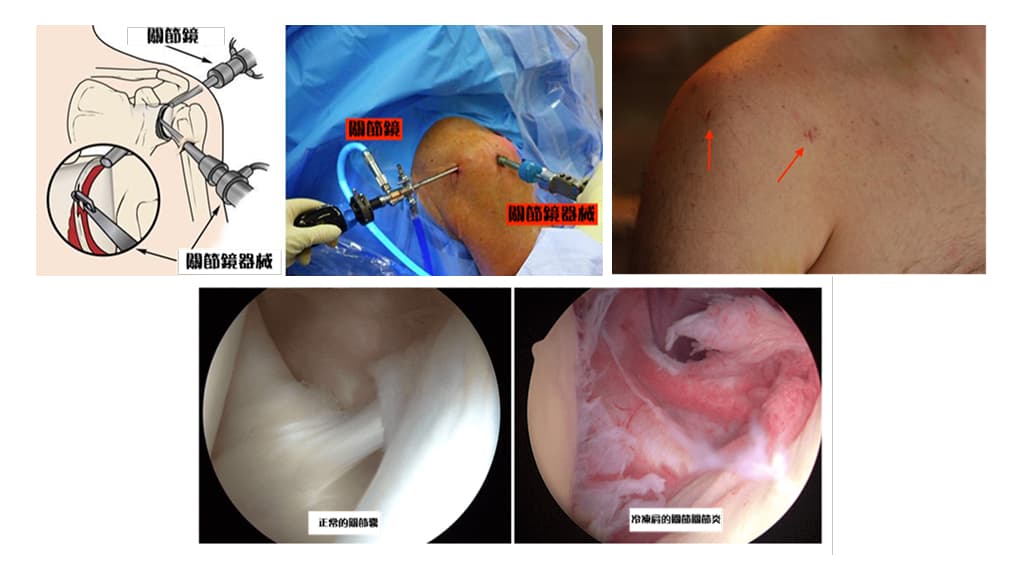 frozen-shoulder-causes-symptoms-treatment-2