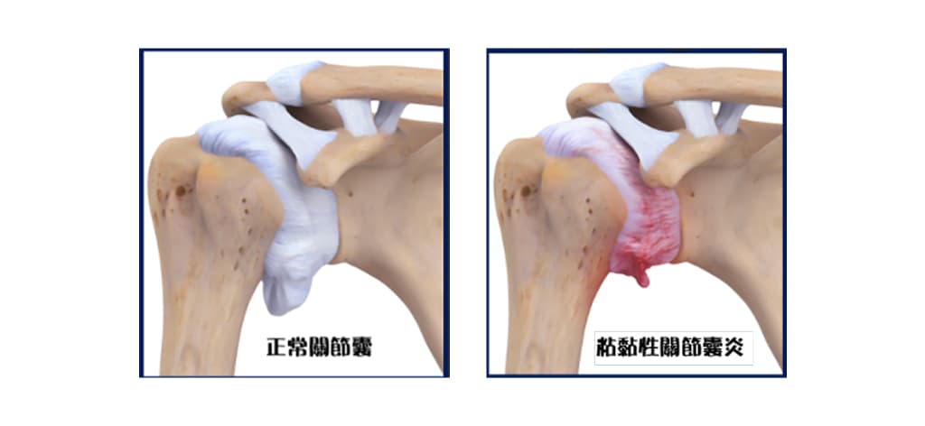 adhesive-capsulitis-frozen-shoulder-info-2